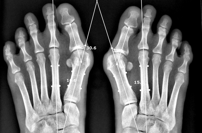 Awareness Bunions Creates Problems not to mention Treatment options